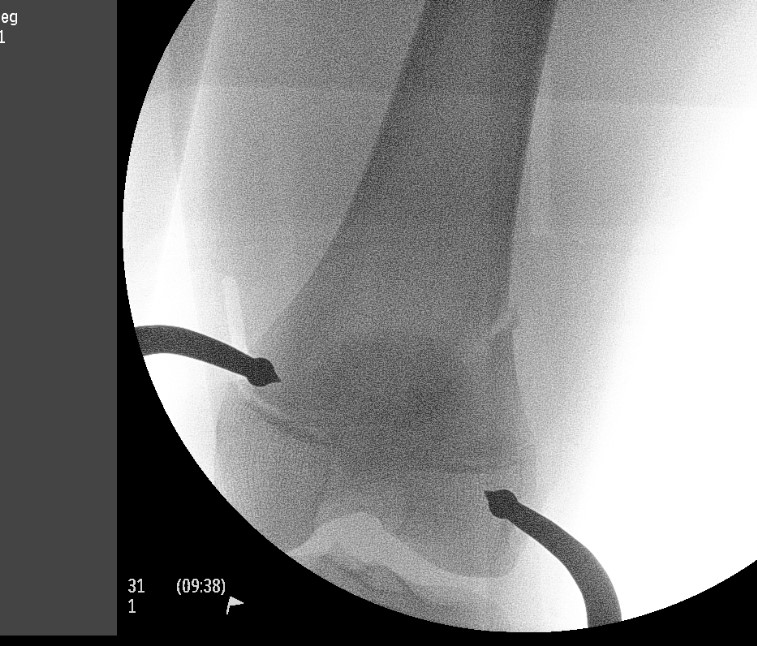 Distal Femur SH2 ORIF